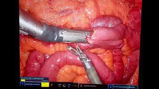 Robotic Gastric Bypass Revision - candy cane resection & distalization