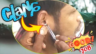 Dry Earwax and White Dirt's Removal ASMR / Most Satisfying Ear Cleaning with Rain Sounds