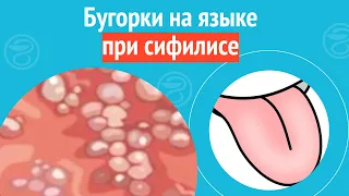 👅 Бугорки на языке при сифилисе. Клинический случай №1079