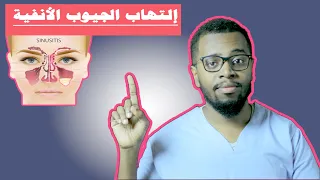 علاج الجيوب الأنفية الحادة والمزمنة .. SINUSITIS