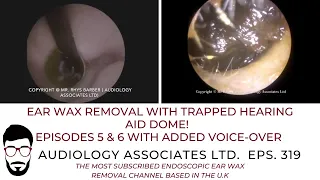 EAR WAX REMOVAL WITH TRAPPED HEARING AID DOME - EP 319