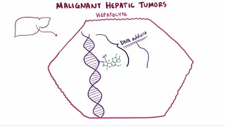 Malignant liver tumors   causes, symptoms, diagnosis, treatment & pathology