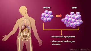 Monoclonal Gammopathy of Undetermined Significance, Smoldering Multiple Myeloma and Multiple Myeloma