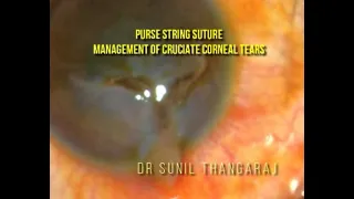 The Purse string suture in Cruciate Corneal tears