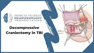 Decompressive Craniectomy in TBI