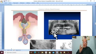 Head and neck surgery in Arabic 9 ( Salivary Calculi ) , by Dr. Wahdan .