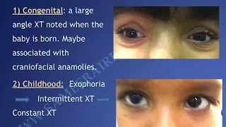 A one hour lecture of Exotropia By Dr Sameera