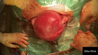 Exteriorizing the uterus. Surgical Technique in cesarean
