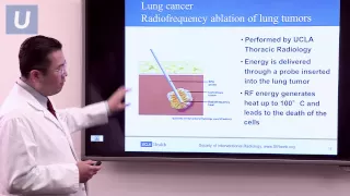 Treatment for Lung Cancer | Jay Lee, MD and Jonathan Goldman, MD | UCLAMDChat