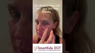 Getting Started - SmartXIDE DOT CO2 Laser Skin Resurfacing Day by Day Actual Patient Live Video ...