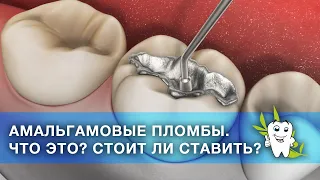 Что такое амальгамовые пломбы? Стоит ли ставить?