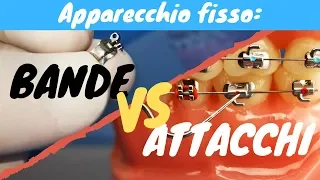 Bande VS attacchi (apparecchio fisso)