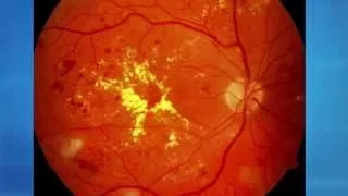 Eye diseases