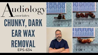 CHUNKY. DARK EAR WAX REMOVAL - EP634