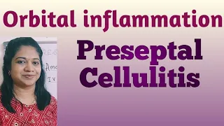 Preseptal cellulitis// Orbital inflammation// Orbit// Ophthalmology// Optometry// Orbital cellulitis