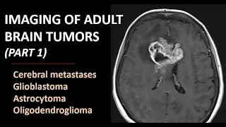 Imaging of brain tumors (part 1): metastases, glioblastoma and beyond...