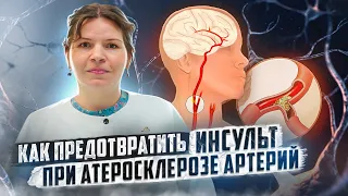 Как предотвратить инсульт при атеросклерозе артерий.