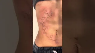 Laser Tattoo Removal