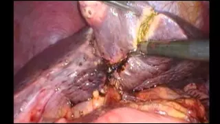 Surgery for Colerectal Cancer Liver Metastases