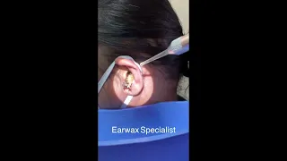 Removing Massive Earwax From Woman's Ear