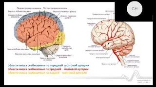 Инсульт - острое нарушение мозгового кровообращения