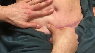 Tummy Tuck Scar 3 Months After Surgery | Dr. Piazza Explains