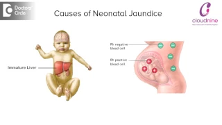 Causes of Neonatal Jaundice - Dr. Kishore Kumar | Cloudnine Hospitals