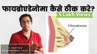 Breast Fibroadenoma explained in Hindi | Dr. Vishal Tomar | Open Consult