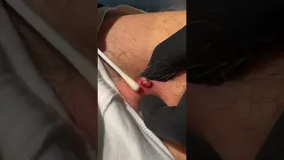 ONE MORE ABSCESS | PT 2