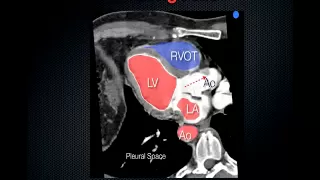 FATE Exam: Focused Assessed Transthoracic Echo