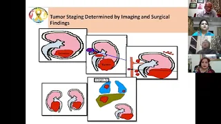 Role of Image Defined Risk Factors(IDRF) in the Management of Pediatric Solid Tumors