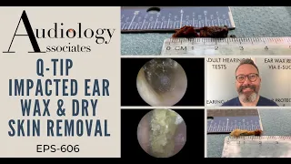 Q-TIP IMPACTED EAR WAX & DRY SKIN REMOVAL - EP606