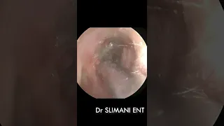 EAR WAX SUCTION ATTACHED TO TYMPANIC MEMBRANE