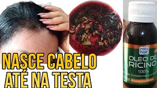 O CABELO CRESCE MUITO, (e não cai nem 1 fio) MELHOR TÔNICO DO MUNDO PARA CRESCER CABELO😱 adeus QUEDA