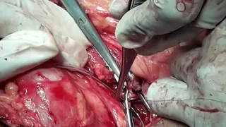 splenorenal anastomosis - 5