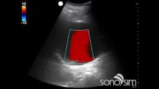 SonoSim Ultrasound Video Challenge - Aorta