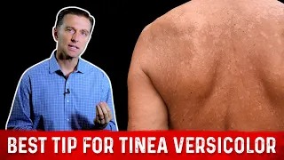 Natural (Skin Fungus) Tinea Versicolor Home Remedies – Dr. Berg