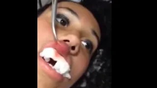 A large worm pulled from her lips l Botfly Removal