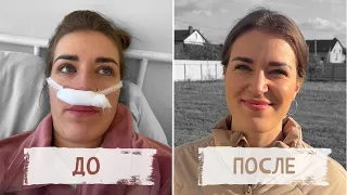 Операция на кривую перегородку носа | ЧТО ВАМ НУЖНО ЗНАТЬ?!
