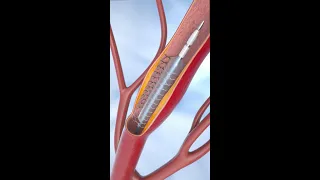 Coronary Angioplasty and Stent Insertion #animation #shorts #anatomy #science #asmr