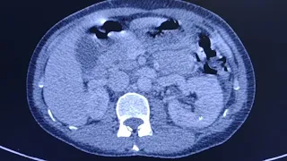 Acute pyelonephritis - CT findings