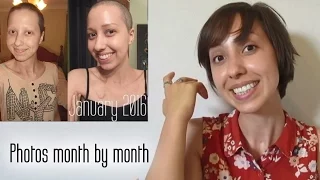 1 Year of Hair Growth After Chemo and Cancer