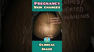 Skin changes in Pregnancy | ObGyn | #shorts