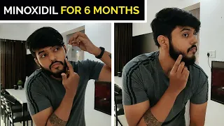 I Tried " MINOXIDIL " for 6 Months !! ( Honest Results ) 🇮🇳