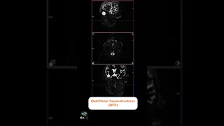 MRI SIALOGRAPHY