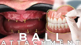 Ball Attachment Dentures / Dental Wise Turkey