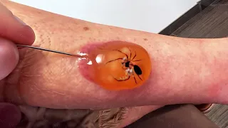 eine Spinne steckt in meiner Blase..