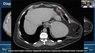 Торако-абдоминальные грыжи, Eric Pauli