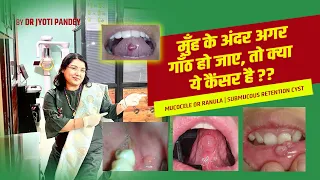 MUCOCELE or RANULA .. मुँह के अंदर अगर गाँठ हो जाए ,तो क्या ये कैंसर है ?? SUBMUCOUS retention cyst.