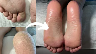 Satisfying Callus Removal From Feet | Cleaning And Massage | No Talking